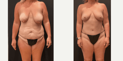 Case 11486 - 35-44 year old woman treated with Mommy Makeover, Breast Lift, Tummy Tuck