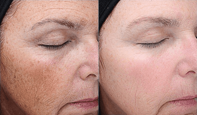 Case 11492 - VI Peel