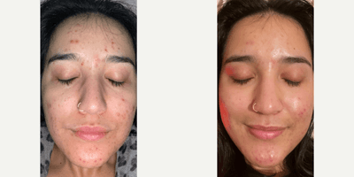 Case 11494 - 25-34 year old woman treated with VI Peel Purify
