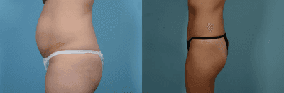 Case 1151 - Woman treated with Tummy Tuck