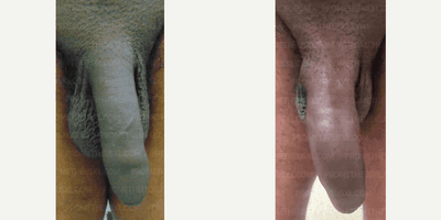 Case 11513 - Man treated with Penis Fillers, Penis Enlargement