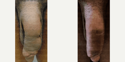 Case 11515 - Man treated with Penis Fillers, Penis Enlargement