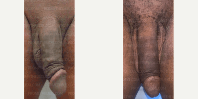 Case 11516 - Man treated with Penis Fillers, Penis Enlargement