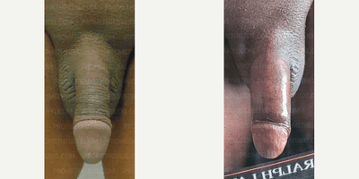 Case 11517 - Woman treated with Penis Enlargement