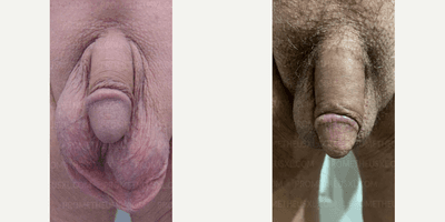 Case 11518 - Woman treated with Penis Enlargement