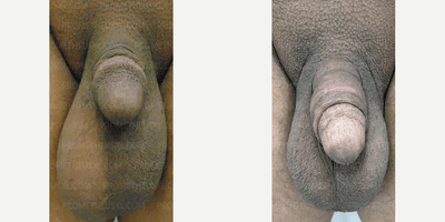 Case 11519 - Woman treated with Penis Enlargement