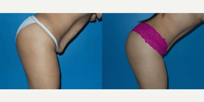 Case 1153 - Woman treated with Tummy Tuck