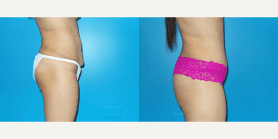 Case 1154 - Woman treated with Tummy Tuck