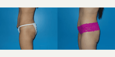 Case 1155 - Woman treated with Tummy Tuck