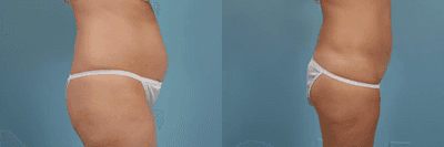 Case 1157 - Woman treated with Tummy Tuck