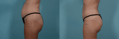 Case 1158 - Woman treated with Tummy Tuck