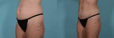 Case 1159 - Woman treated with Tummy Tuck