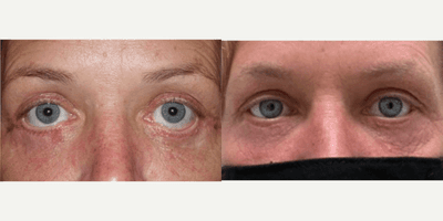 Case 11735 - Eyelid Retraction Repair