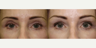 Case 11737 - Restylane