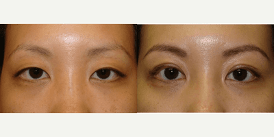 Case 11739 - Double Eyelid Surgery