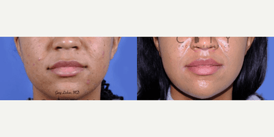 Case 11747 - Lip Lift