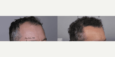 Case 11748 - Hair Transplant