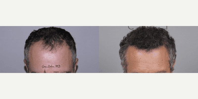 Case 11749 - Fue Hair Transplant