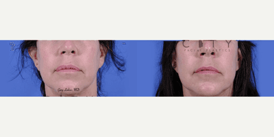 Case 11751 - Lip Reduction