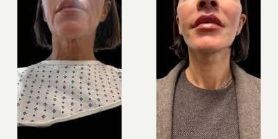 Case 11755 - Neck Lift