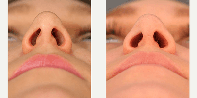 Case 11762 - Rhinoplasty