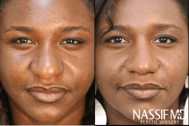 Case 11767 - African American Rhinoplasty