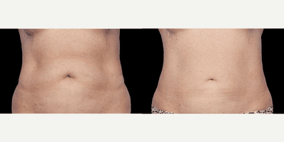Case 11769 - Coolsculpting