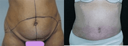 Case 11771 - Tummy Tuck
