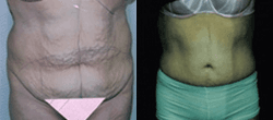 Case 11772 - Panniculectomy