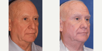 Case 11776 - Rhinoplasty