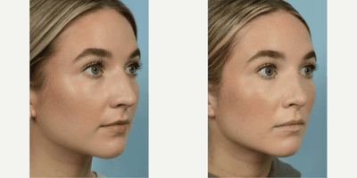 Case 11780 - Rhinoplasty