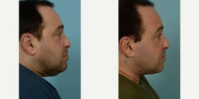 Case 11781 - Neck Lift