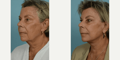 Case 11782 - Facelift