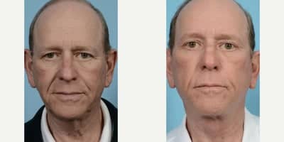 Case 11783 - Eyelid Surgery