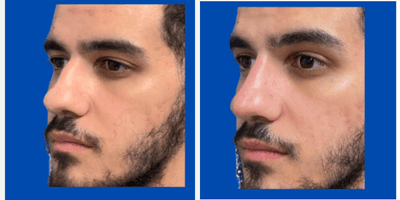 Case 11787 - Nonsurgical Nose Job