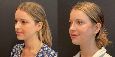 Case 11792 - Revision Rhinoplasty