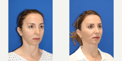 Case 11794 - Facial Fat Transfer