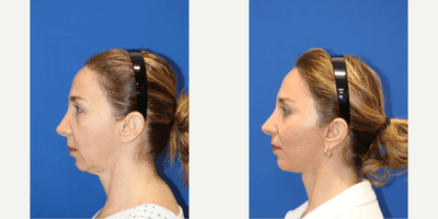 Case 11795 - Eyelid Surgery