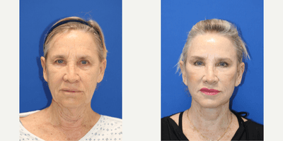 Case 11799 - Lip Lift