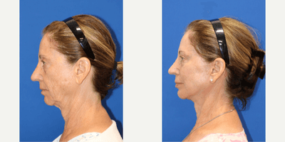 Case 11800 - Double Eyelid Surgery