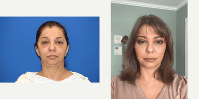 Case 11801 - Smas Facelift