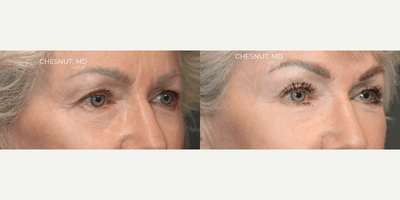 Case 11805 - Brow Lift
