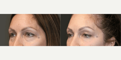 Case 11808 - Juvederm