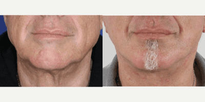 Case 11814 - Lower Facelift