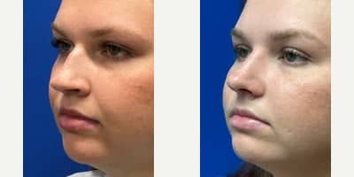 Case 11821 - Rhinoplasty
