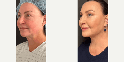 Case 11837 - Lip Lift