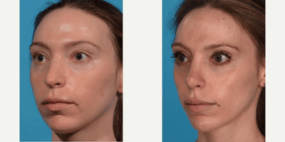 Case 11842 - Revision Rhinoplasty