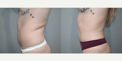 Case 11849 - Liposuction