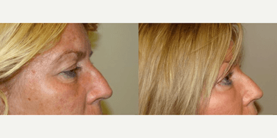 Case 11850 - Brow Lift