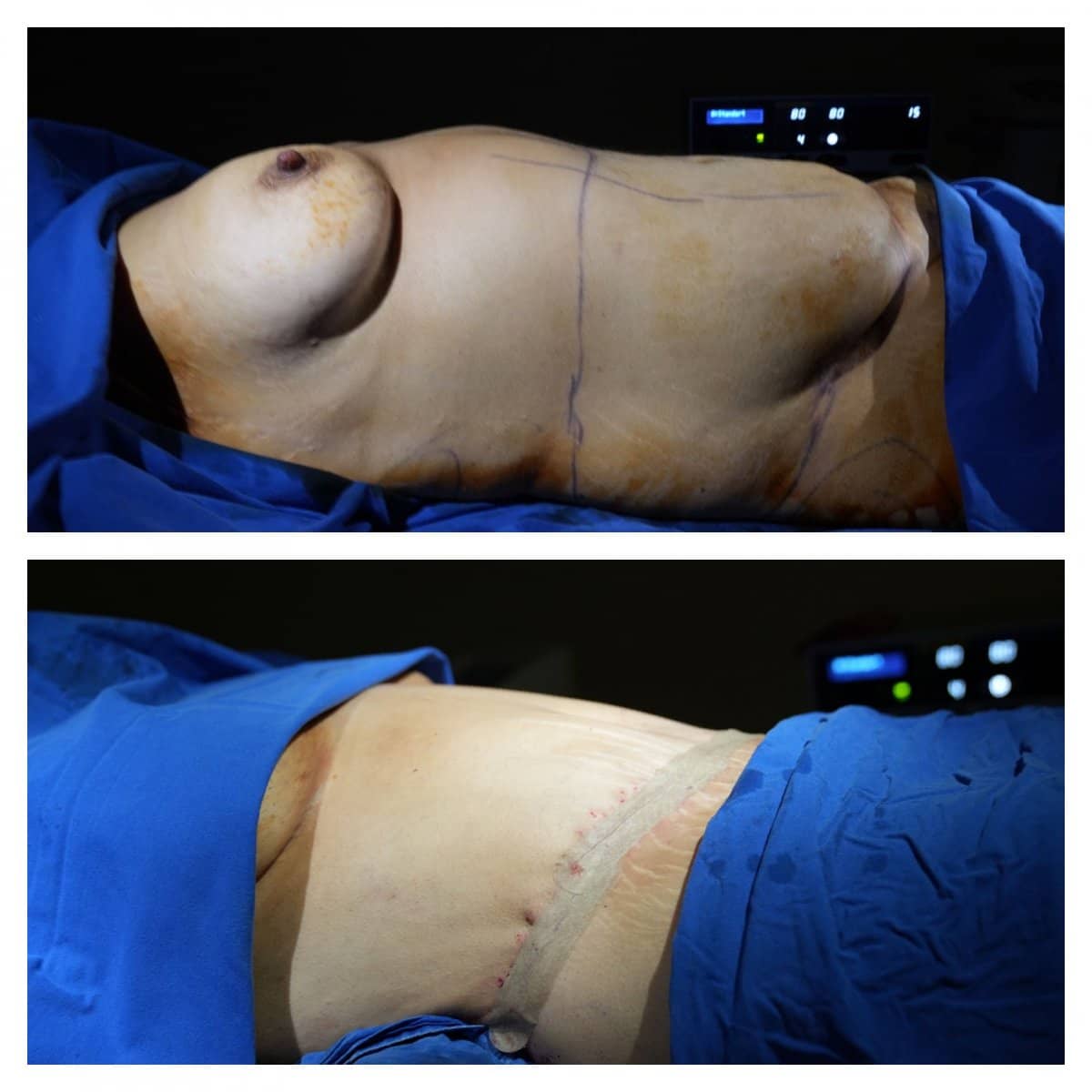 Case 11871 - Brazilian Butt Lift